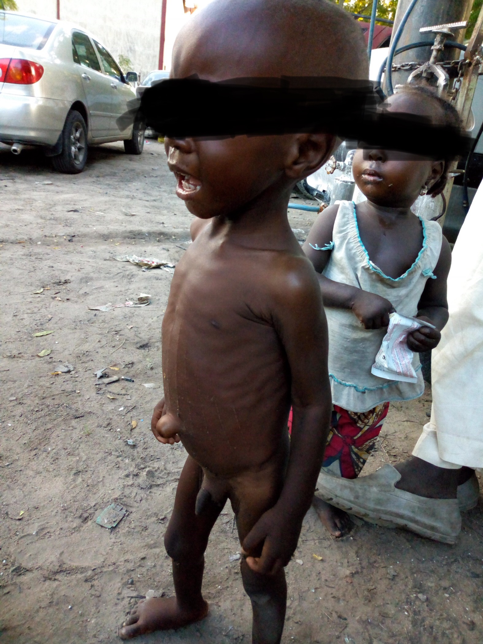 Malnutrition: What DFID’s N18.5 Billion donation will achieve in Borno, Yobe